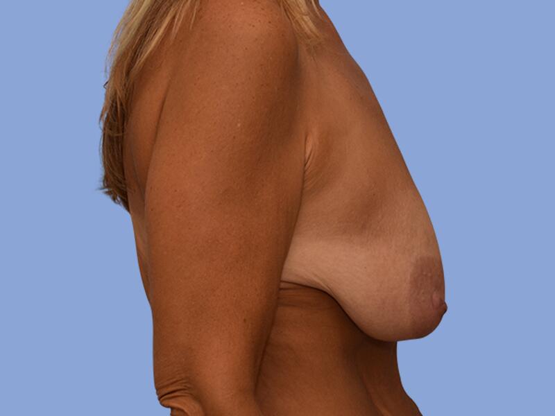 Breast lift before & after photo